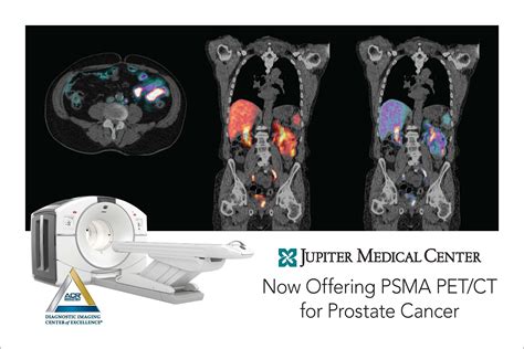 PET Scan: Now Performing PSMA Scans .